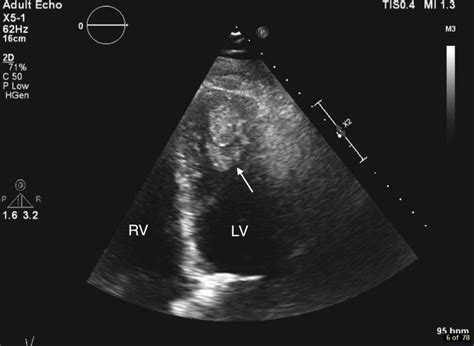 lv mural thrombus treatment guidelines